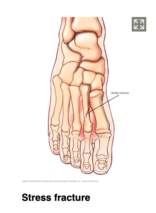 Stress fractures?